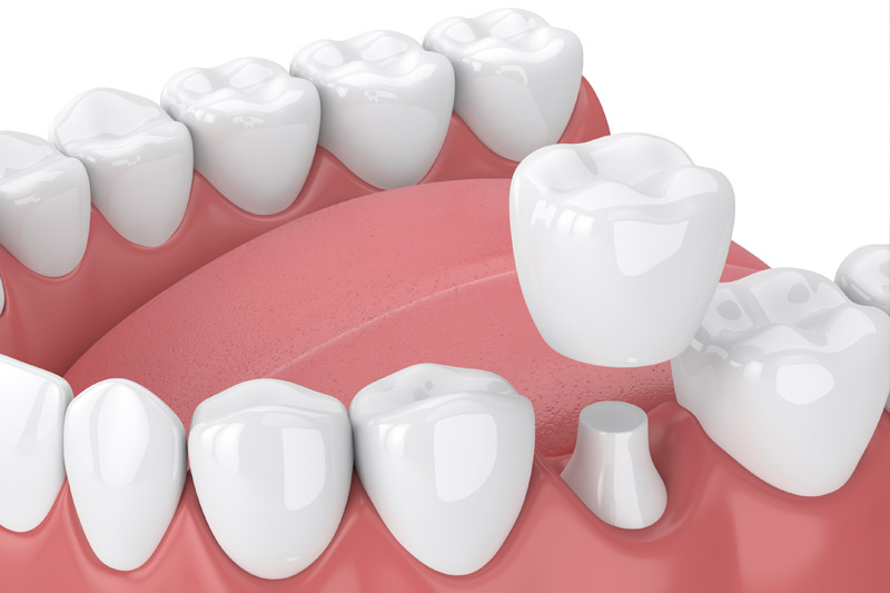 Dental Crowns in Elmhurst