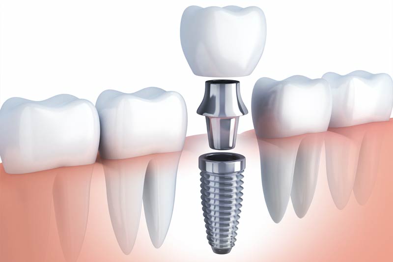 Implants Dentist in Elmhurst