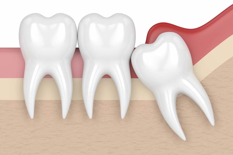Wisdom Tooth Removal in Elmhurst